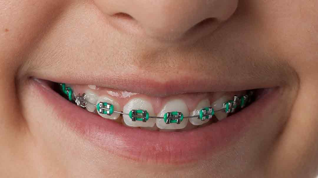 Foods to Avoid When Wearing Braces.